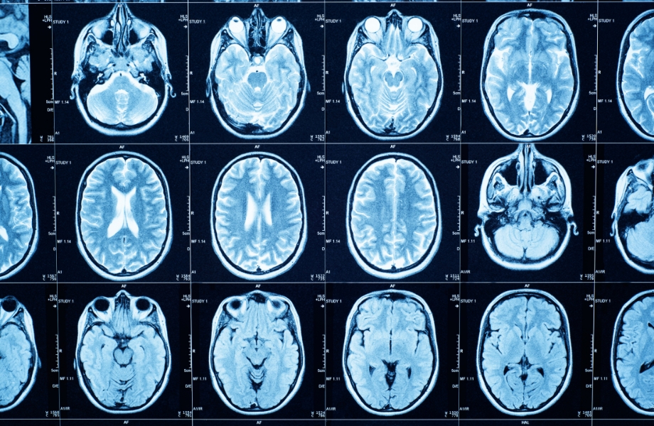 Brain scan results