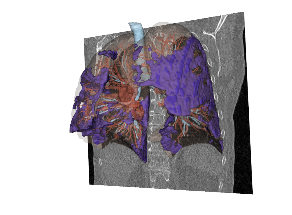 AI image simulation of a human lung created from historic imaging data