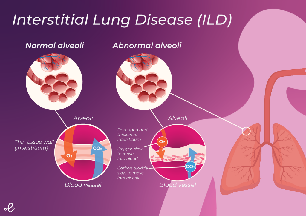 ILD