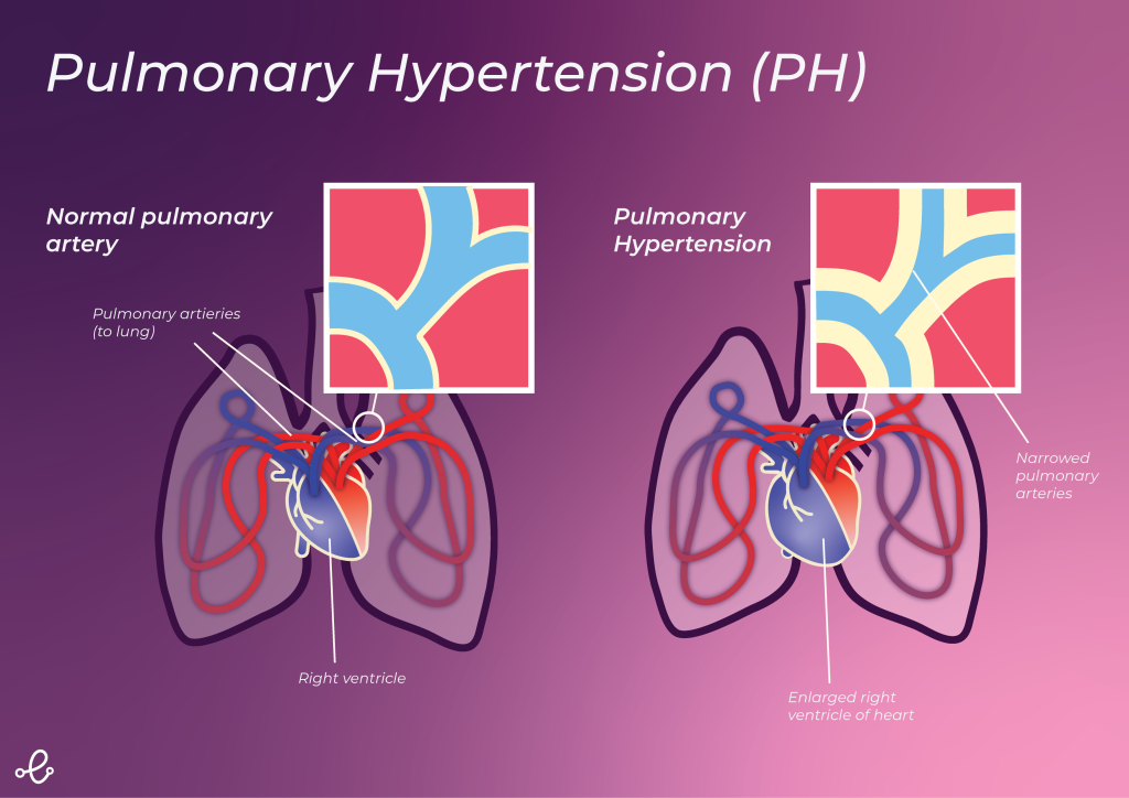 pulmonary hypertension