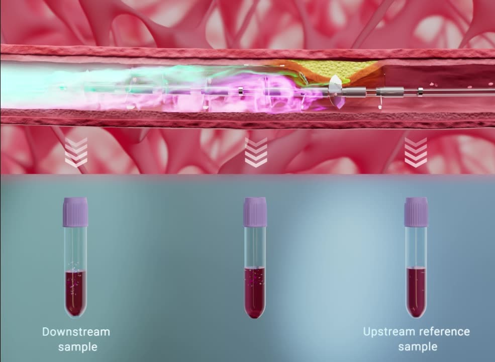 Simultaneous blood samples collected upstream and downstream of coronary plaque using the Liquid Biopsy System