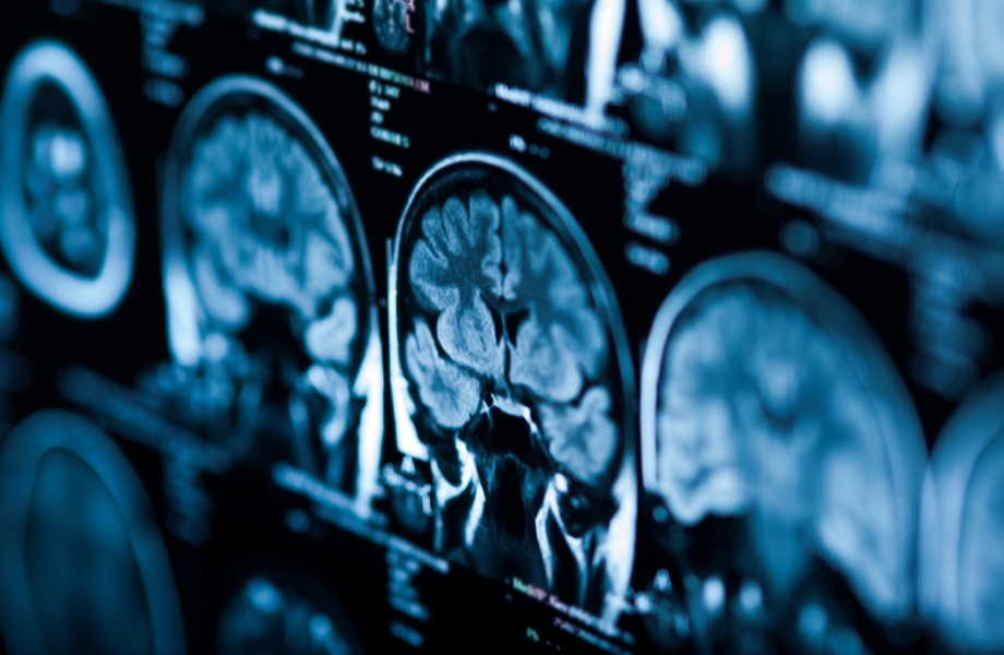 Brain scan results