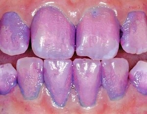 Teeth stained purple where there's plaque