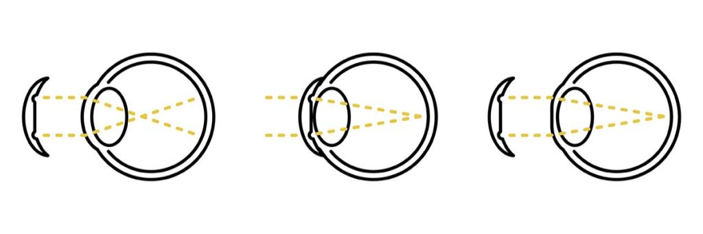 Diagram of Ortho-K lenses