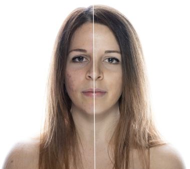 Acne vulgaris vaccines by VacZine Analytics