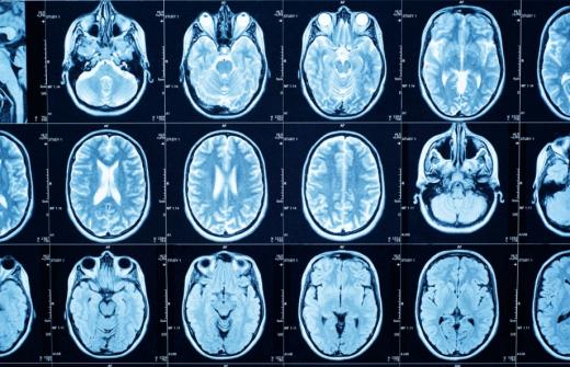 Brain scan results