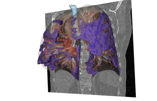 AI image simulation of a human lung created from historic imaging data