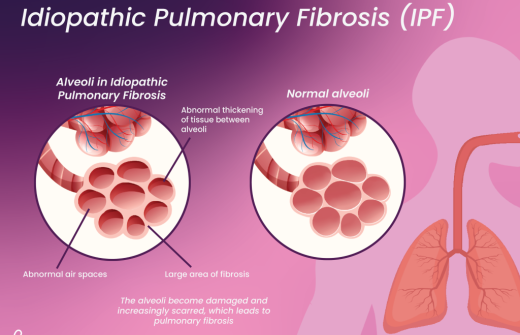 idiopathic pulmonary fibrosis