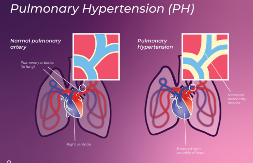 pulmonary hypertension