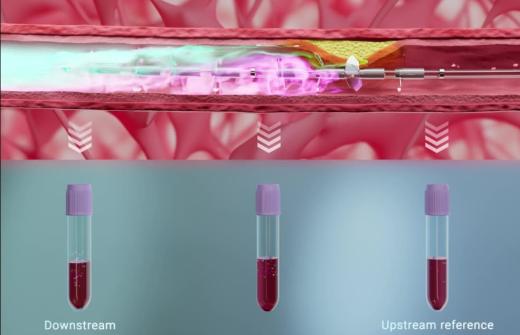 Simultaneous blood samples collected upstream and downstream of coronary plaque using the Liquid Biopsy System