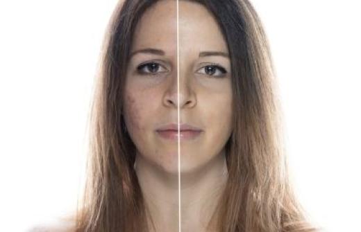 Acne vulgaris vaccines by VacZine Analytics