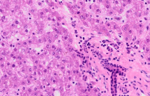 cancer cells