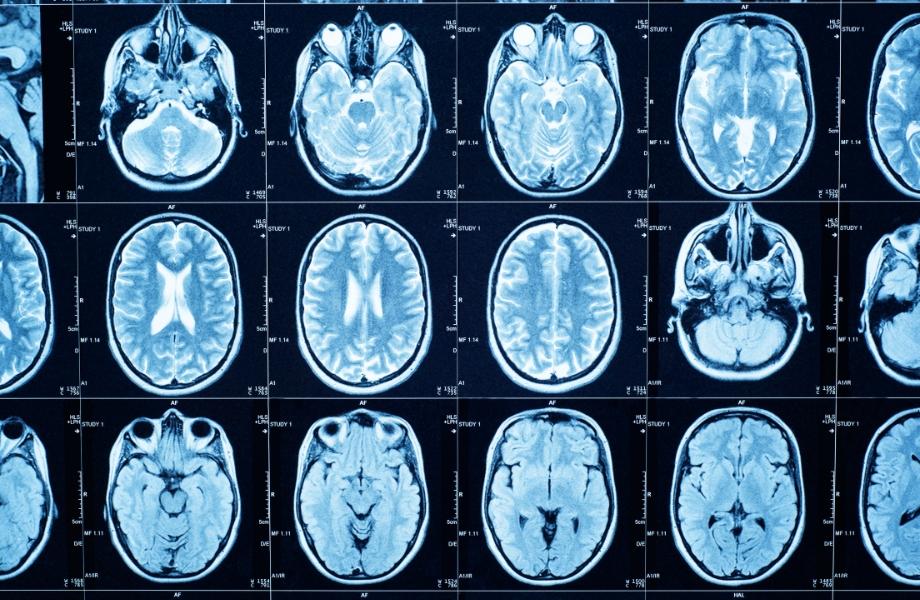 Brain scan results
