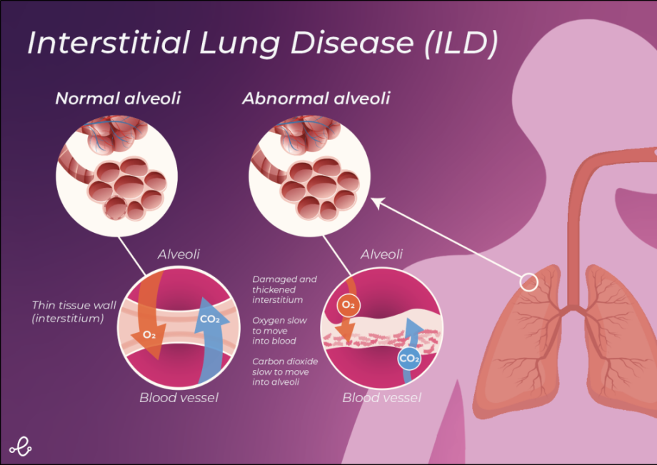  Interstitial Lung Disease