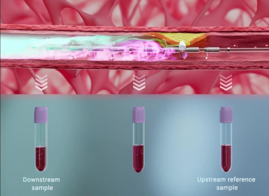 Simultaneous blood samples collected upstream and downstream of coronary plaque using the Liquid Biopsy System
