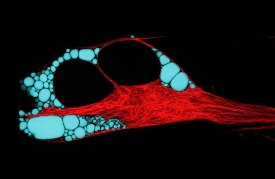An image of a human neuron, as seen under high resolution microscope, with pathologically perturbed ER. Image - Avezov Lab