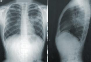 lung x rays