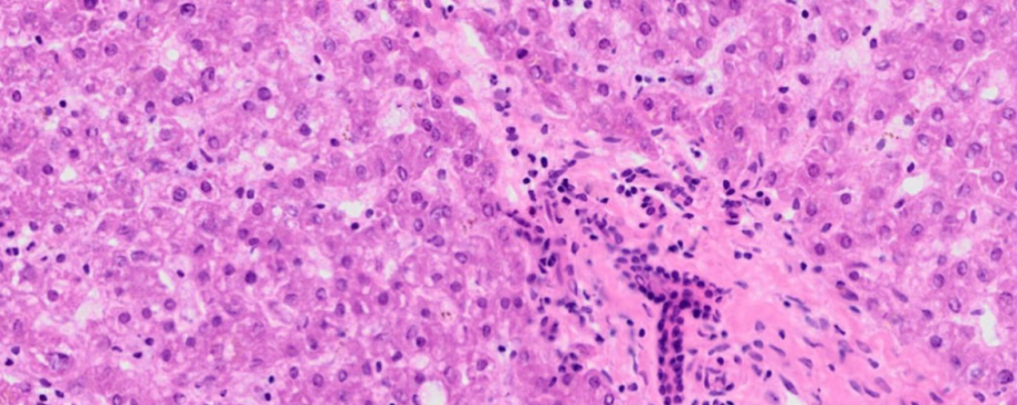 cancer cells